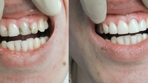 Лучшие причины для проведения реставрации зубов в профессиональной клинике